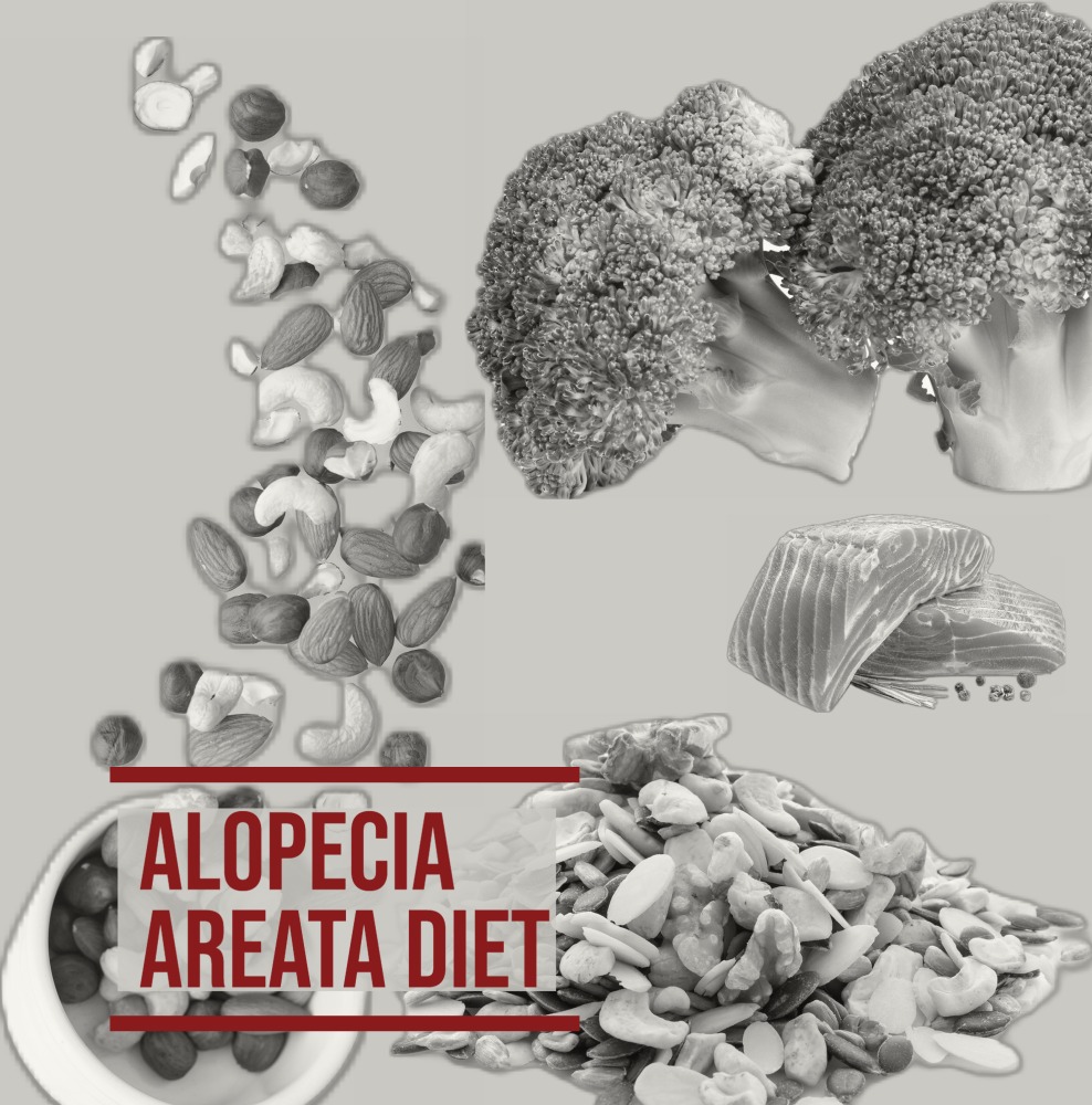 alopecia-areata-crown-hair-transplant