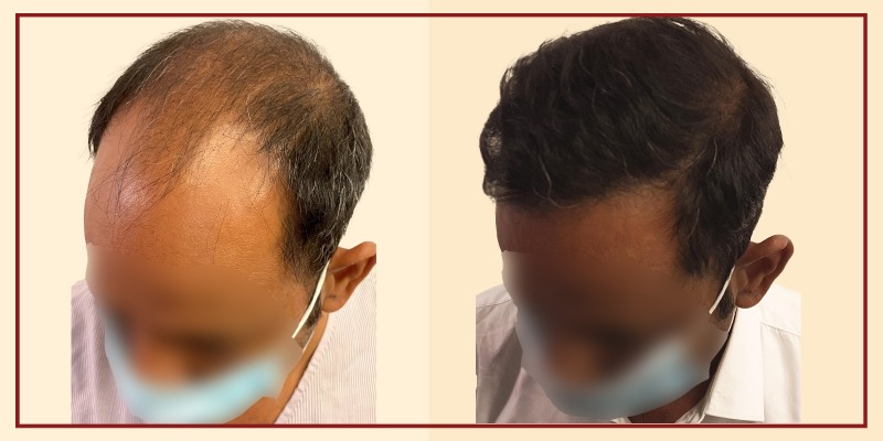 Before and after results, Left Tilt view of patient 4