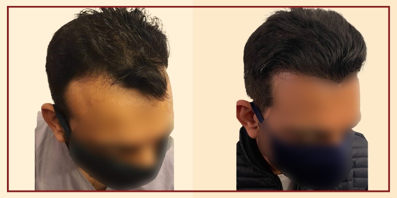 Before and after results of Patient 2. Right view.
