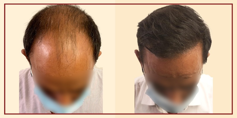 Before and after results, Front Tilt view of patient 4