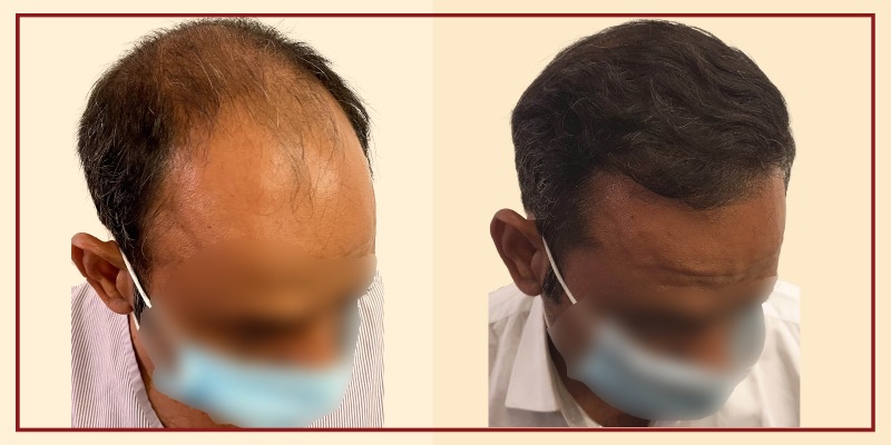 Before and after results, Right Tilt view of patient 4