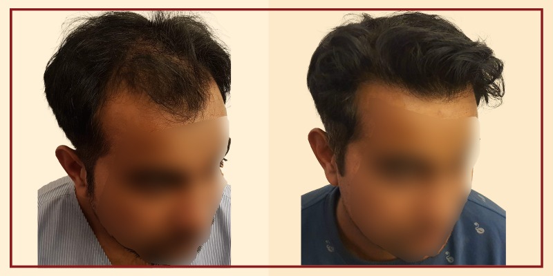 Before-and-after-result-of-patient-36