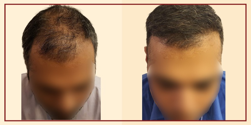 Before and after result of patient 43