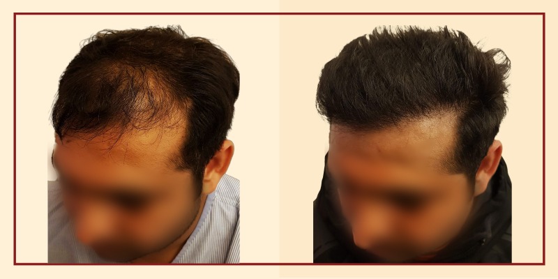 Before and after result of patient 45