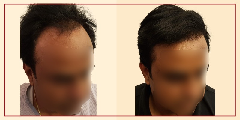 Before and after result of patient 50