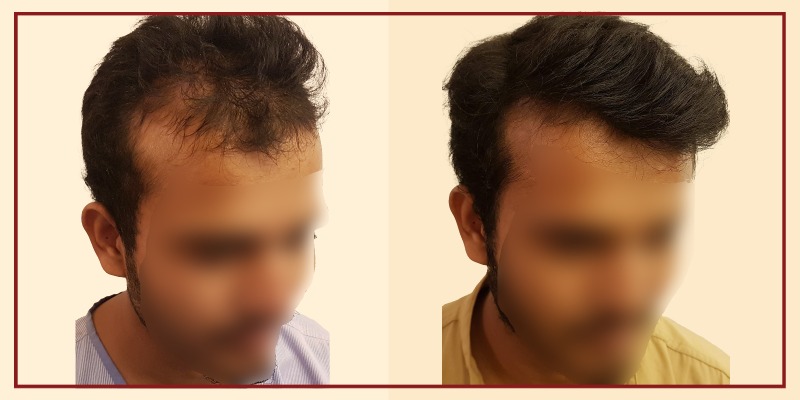 Before and after result of patient 72