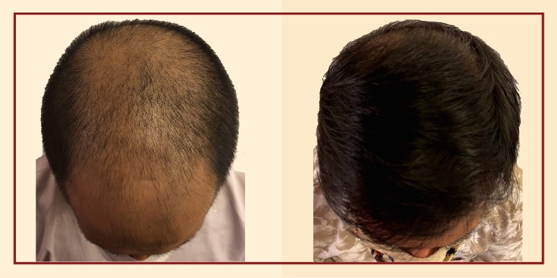 Before and after results, crown view of patient 1
