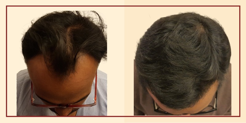 Before-and-after-results-crown-view-patient-29-400x800