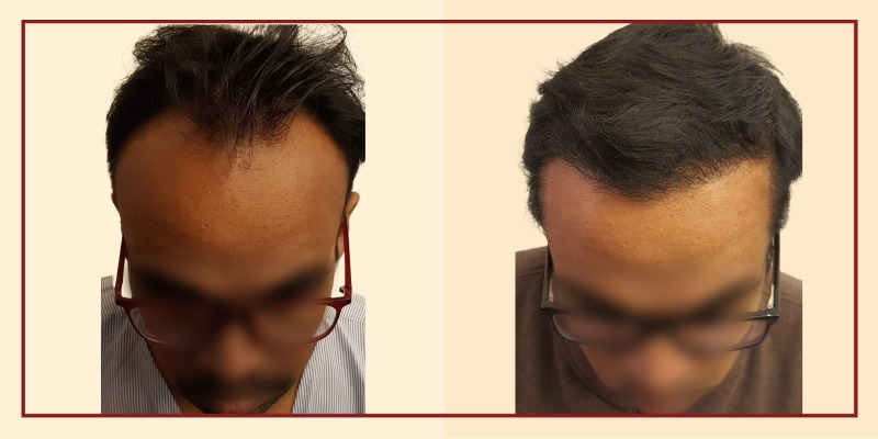 Before and after results, front tilt view of patient 29