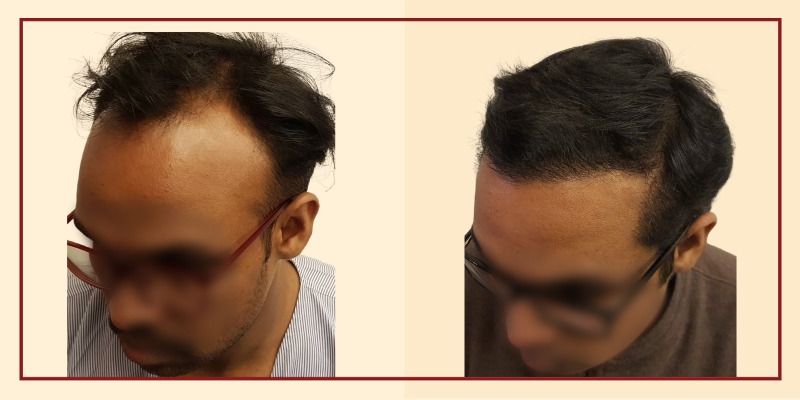 Before and after results, left tilt view of patient 29