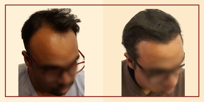 Before and after results, right tilt view of patient 29