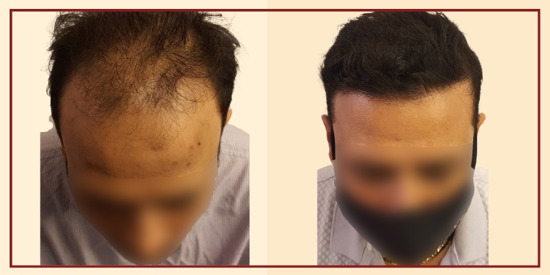 Before and after results, Front Tilt view of patient 18