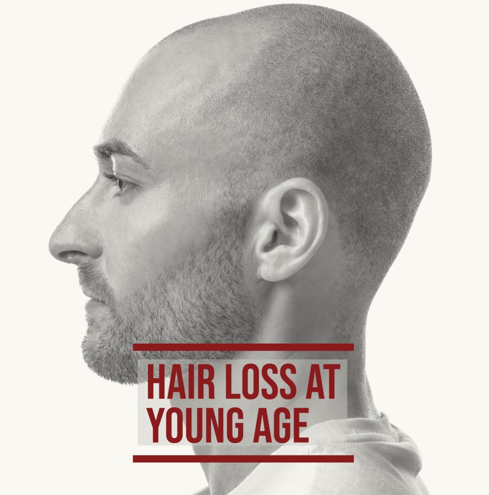 Male model who suffers hair loss at a young age