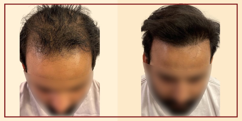 Before-and-after-results-front-tilt-view-patient-6-400x800