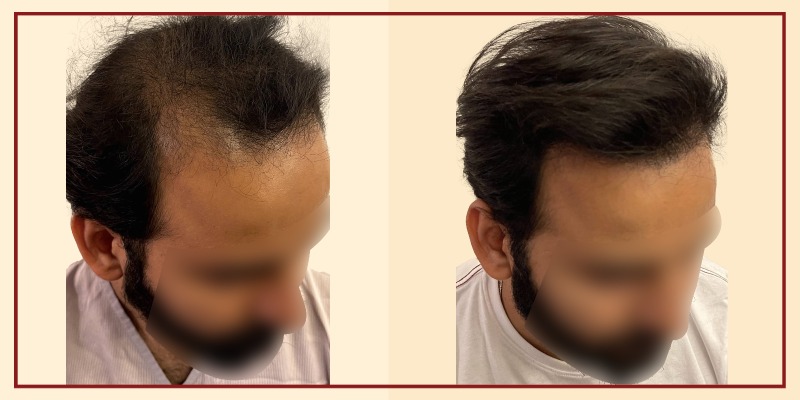 Before-and-after-results-right-tilt-view-patient-6-400x800
