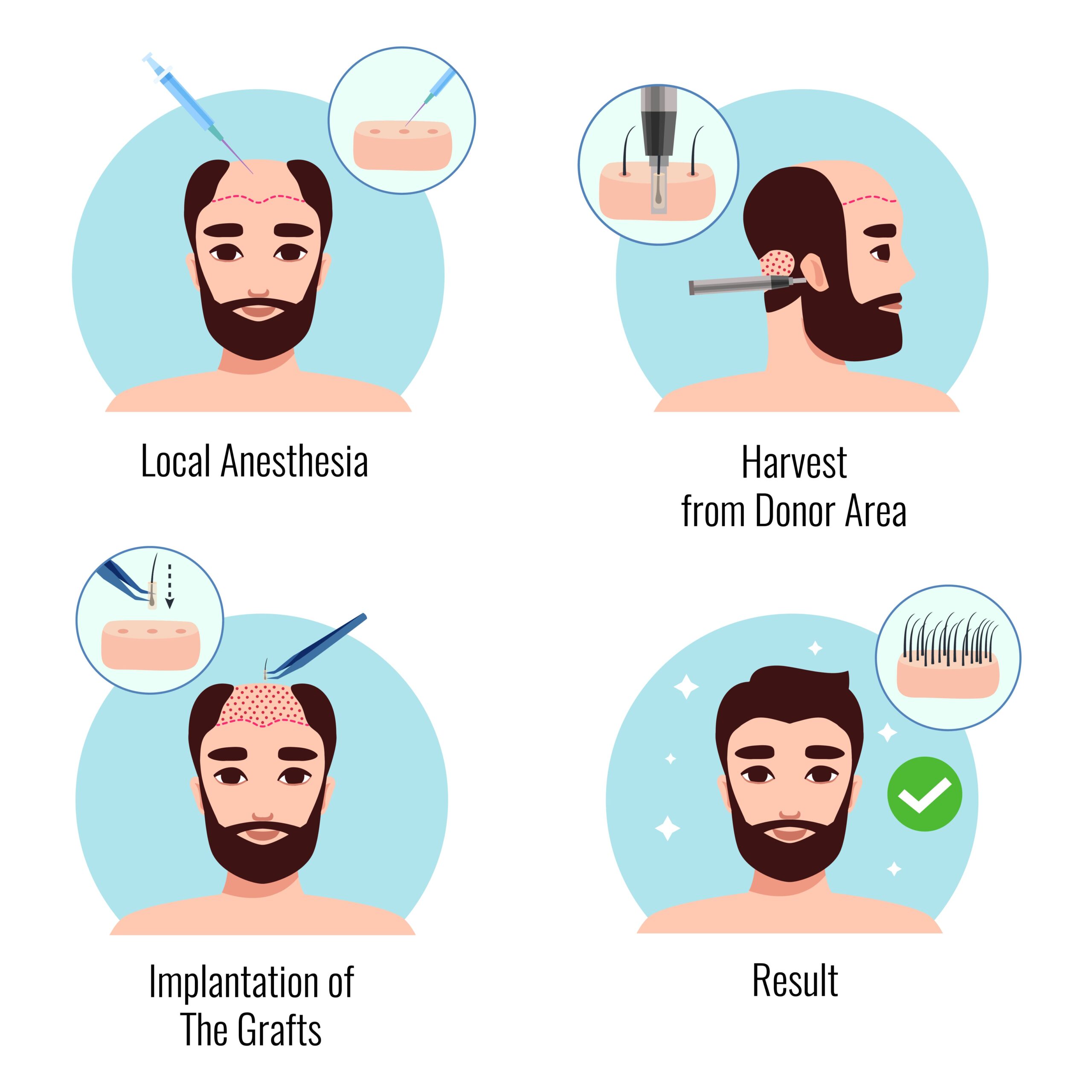 Fue Hair Transplant in Delhi