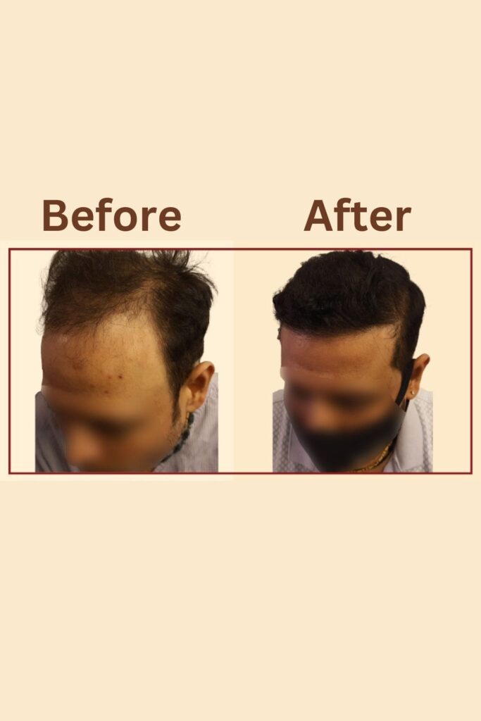 Best Hair Transplant in Delhi