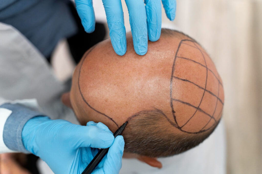 Best Hair Transplant in Delhi