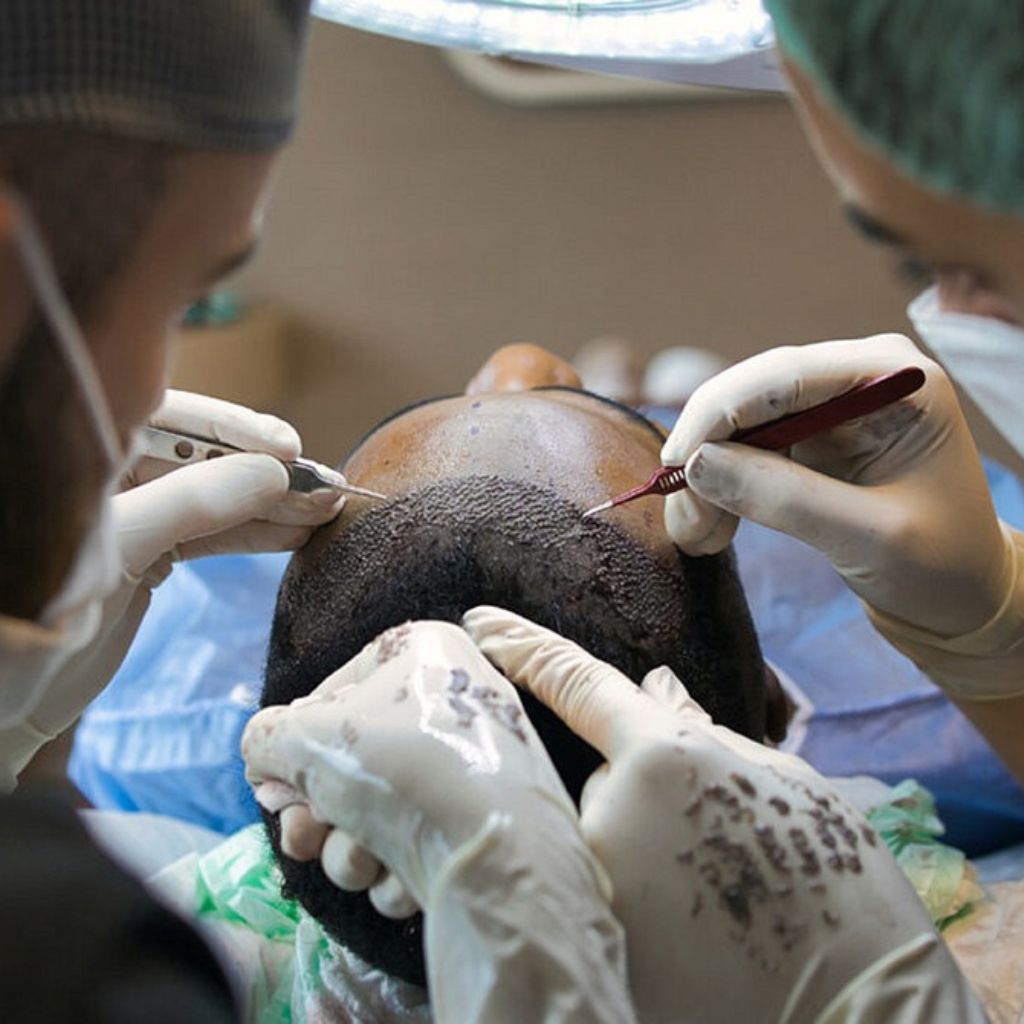 Fue Hair Transplant in Delhi