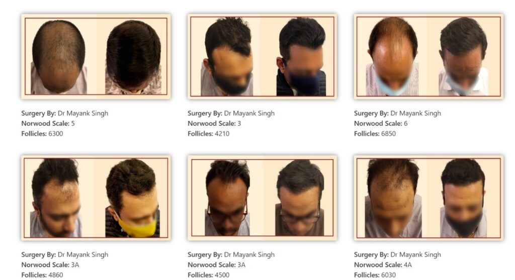 Best hair transplant in delhi