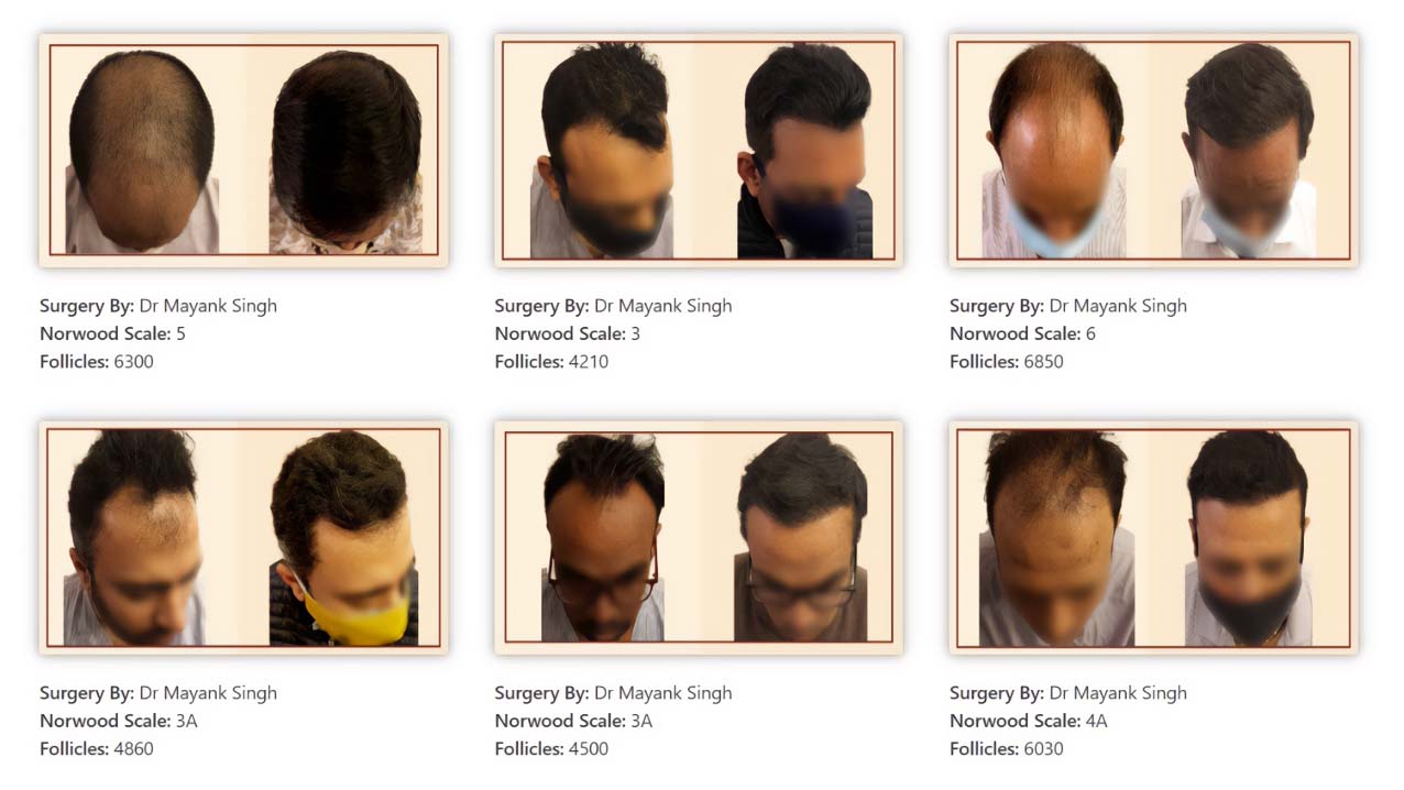 Best Hair Transplant in Delhi