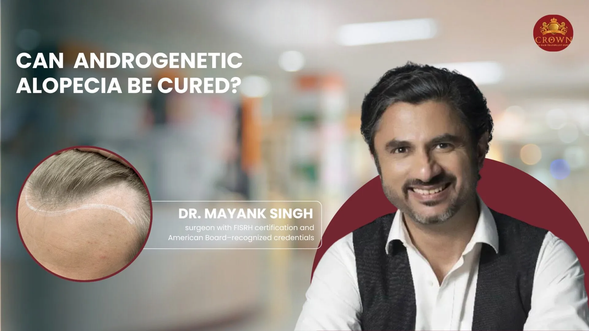 Can  Androgenetic Alopecia Be Cured?