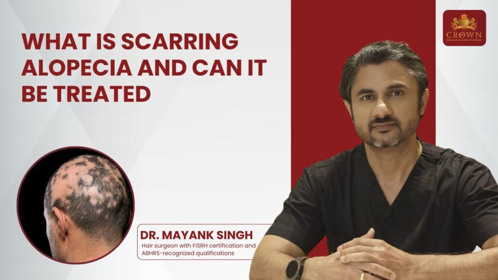 Banner promoting a talk on scarring alopecia: doctor on the right, close-up balding head on the left, with the headline “What is scarring alopecia and can it be treated” and Crown logo in the corner
