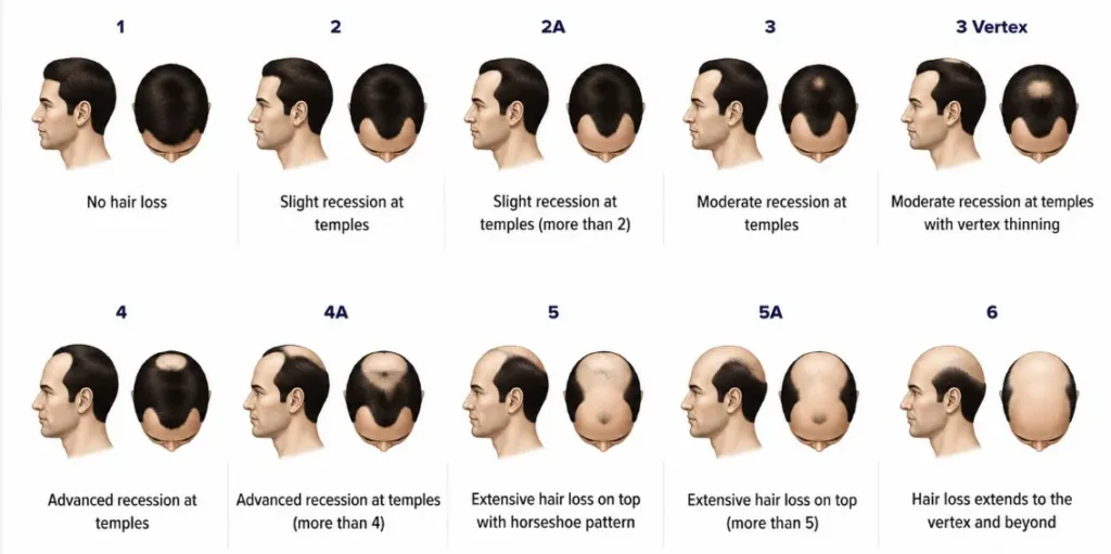 Illustration showing the Norwood Scale stages of male pattern baldness from Stage 1 to Stage 7.