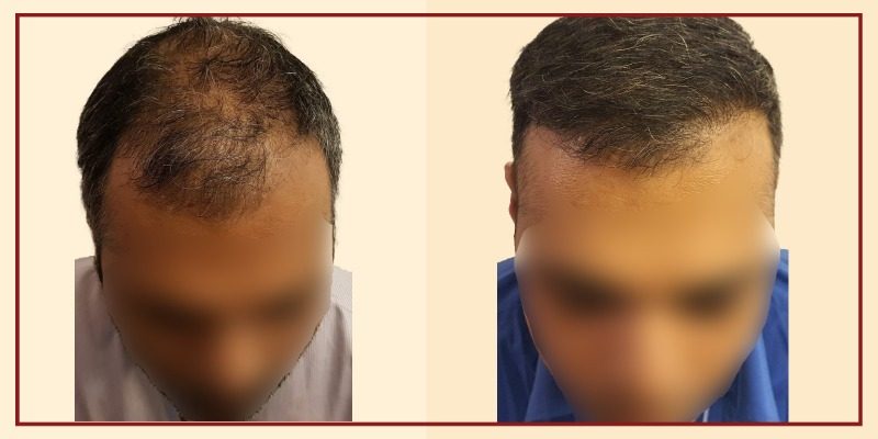 Before-and-after-result-of-patient-43.jpg
