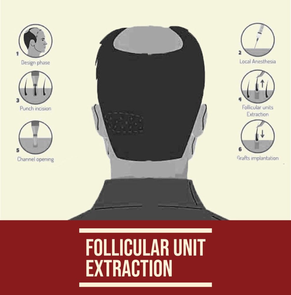Follicular-unit-extraction-988x1000-1.jpg