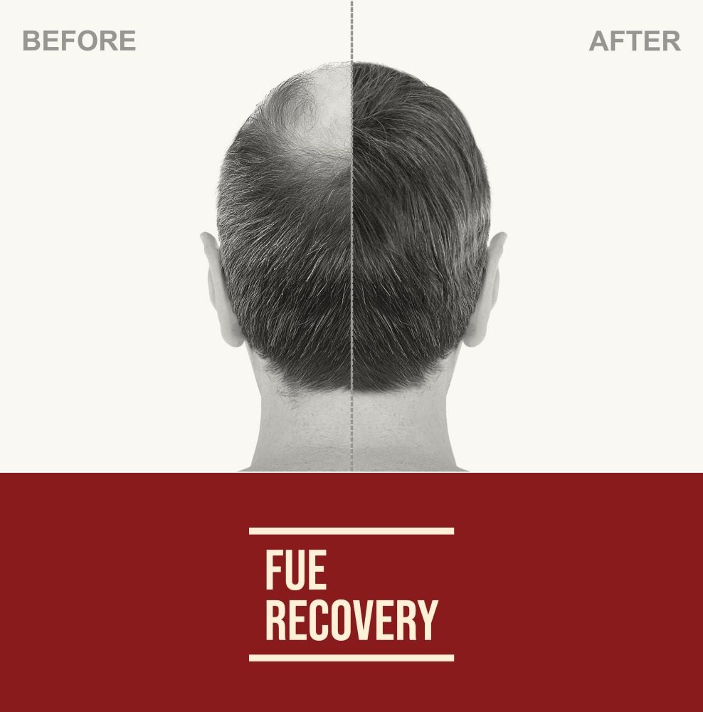 Follicular-unit-extraction-recovery-time-988x1000-1.jpg