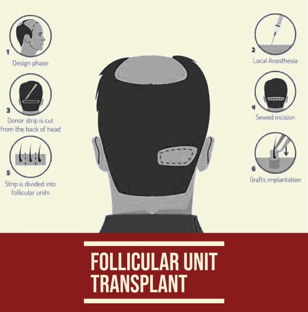 Follicular-unit-transplant-988x1000-1.jpg