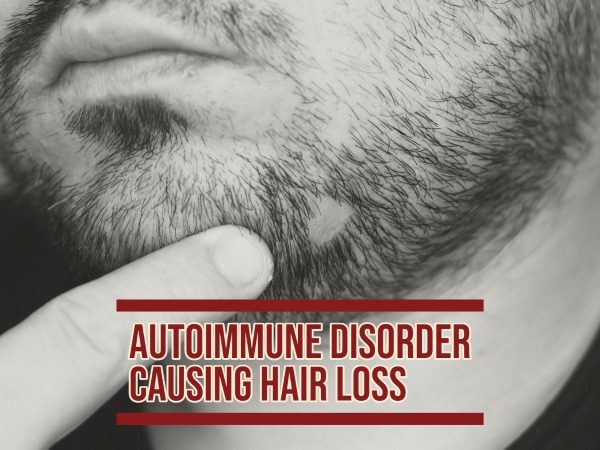 autoimmune-disorder-Alopecia-areata_-600x450-1.jpg