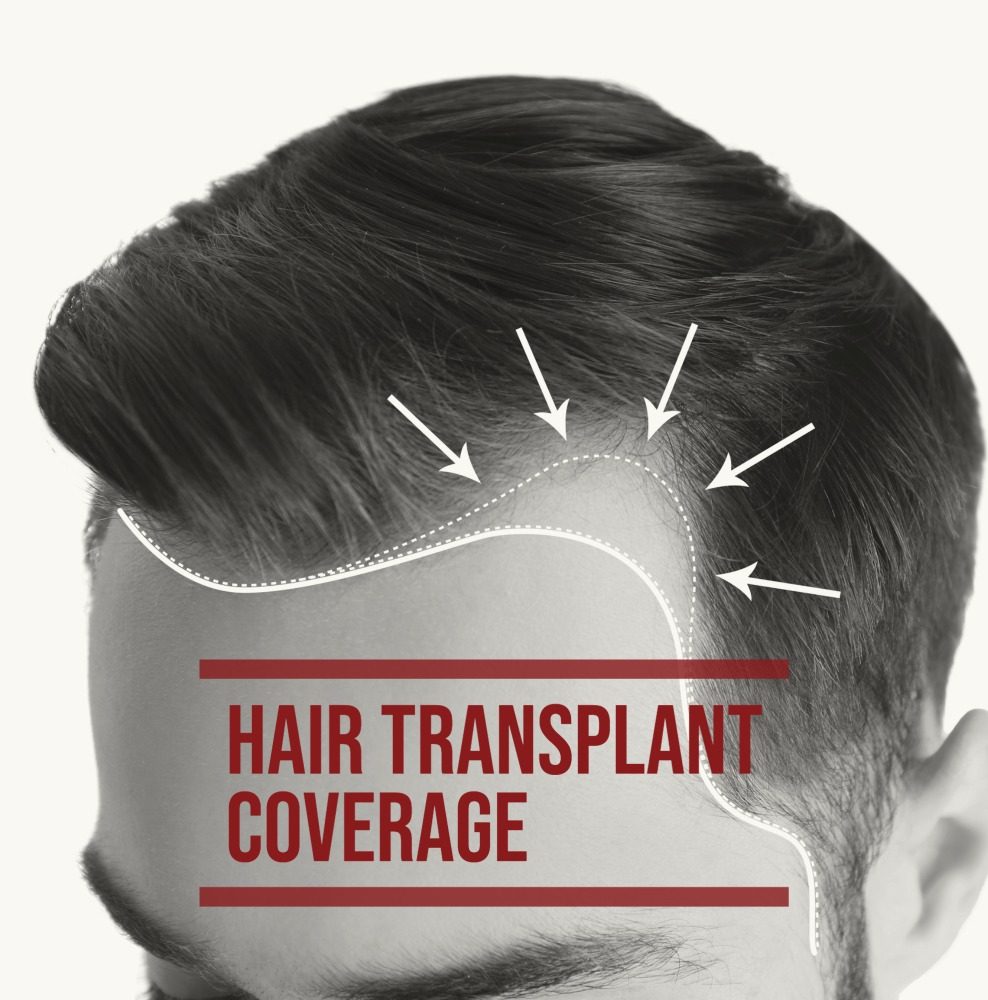 hair-transplant-coverage-988x1000-1.jpg